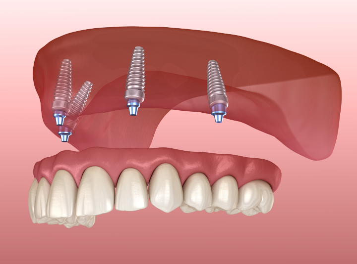 All-on-X (All-on-4) Dental Implants