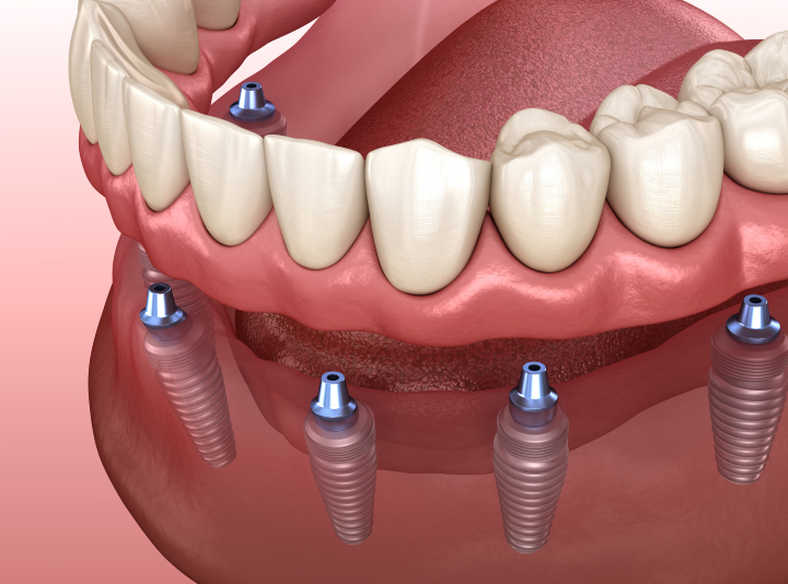 All-on-X (All-on-6) Dental Implants