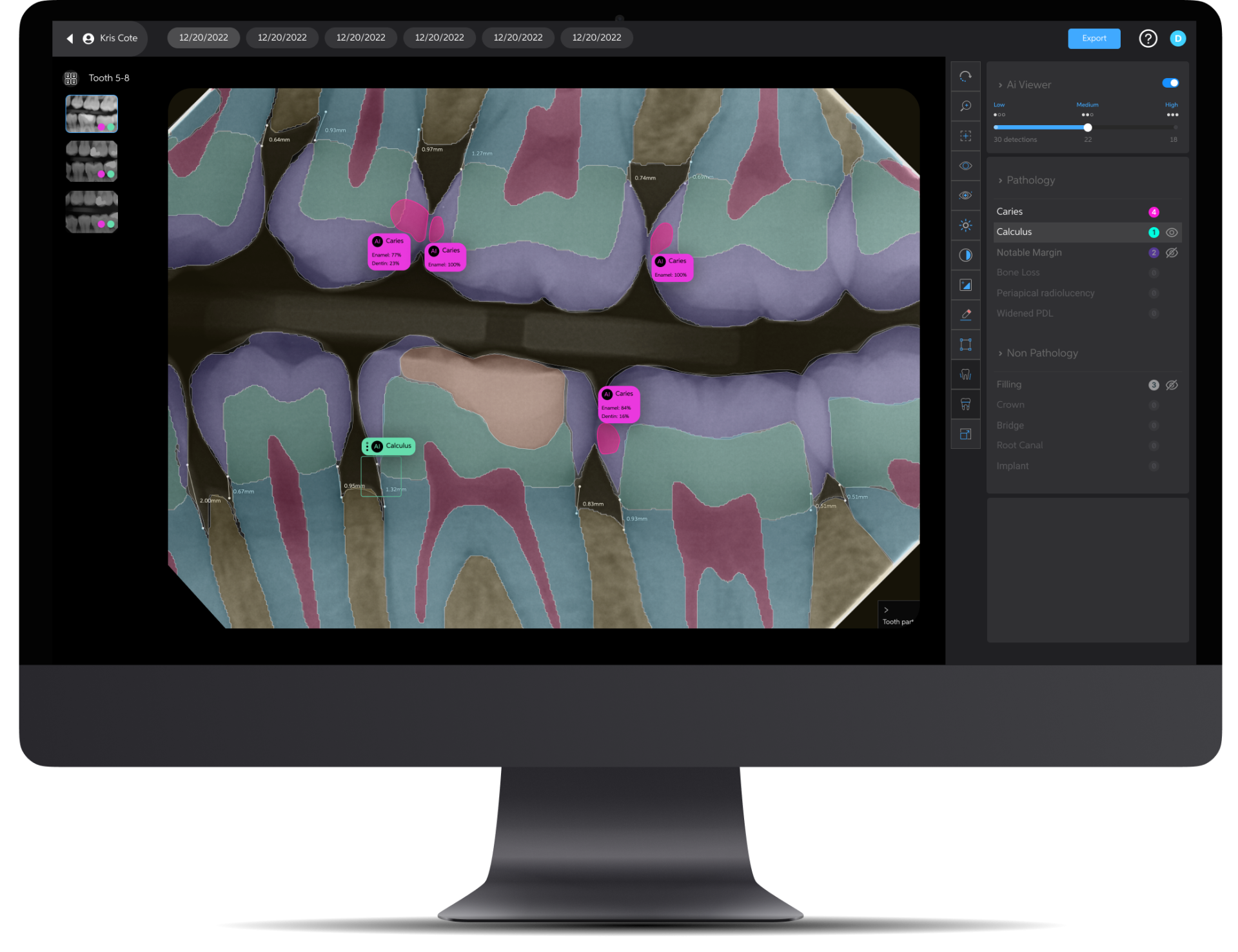 AI X-Ray Analysis