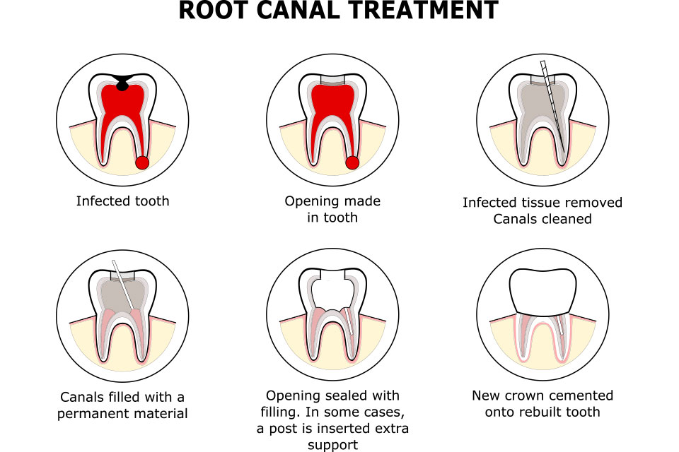 Root Canal Treatment