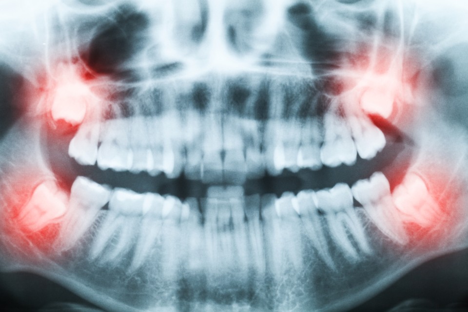 Wisdom Tooth Extraction